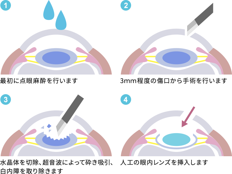 日帰り白内障手術について