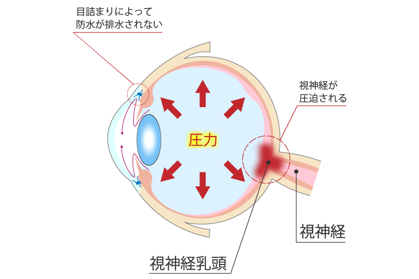 緑内障とは