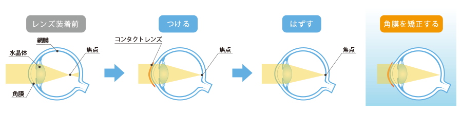 オルソケラトロジーイメージ