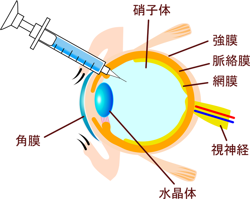 硝子体注射について